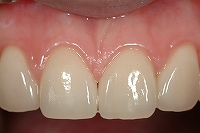ラミネートベニア治療後.jpg